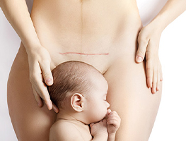 Childbirth - Post natal - caesarean operation